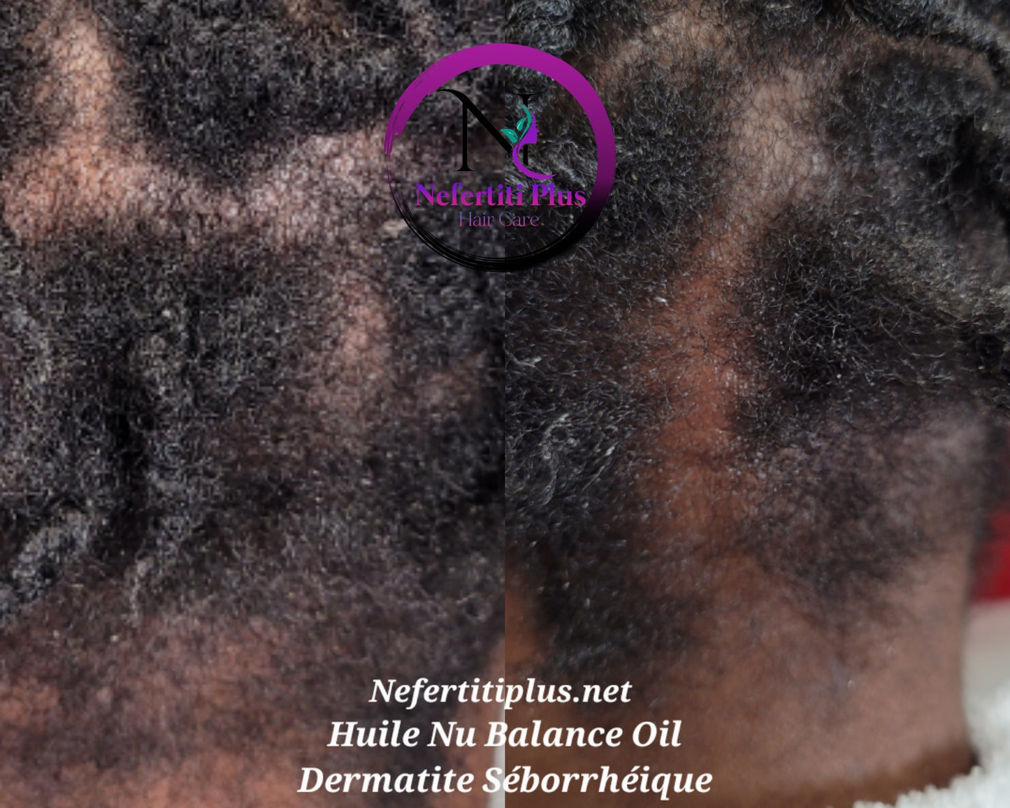 HUILE NU BALANCE OIL - CONTRE DERMATITE SÉBORRHÉIQUE