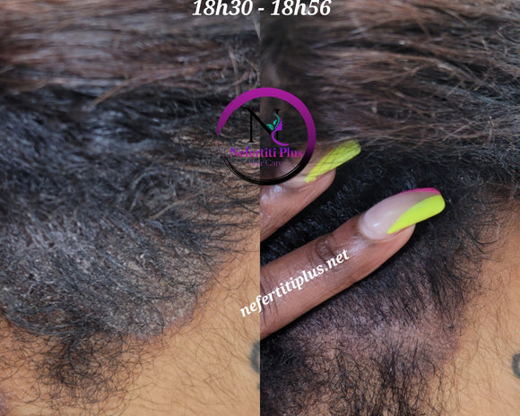 PRODUITS CONTRE PSORIASIS CAPILLAIRES & ECZÉMA CAPILLAIRES