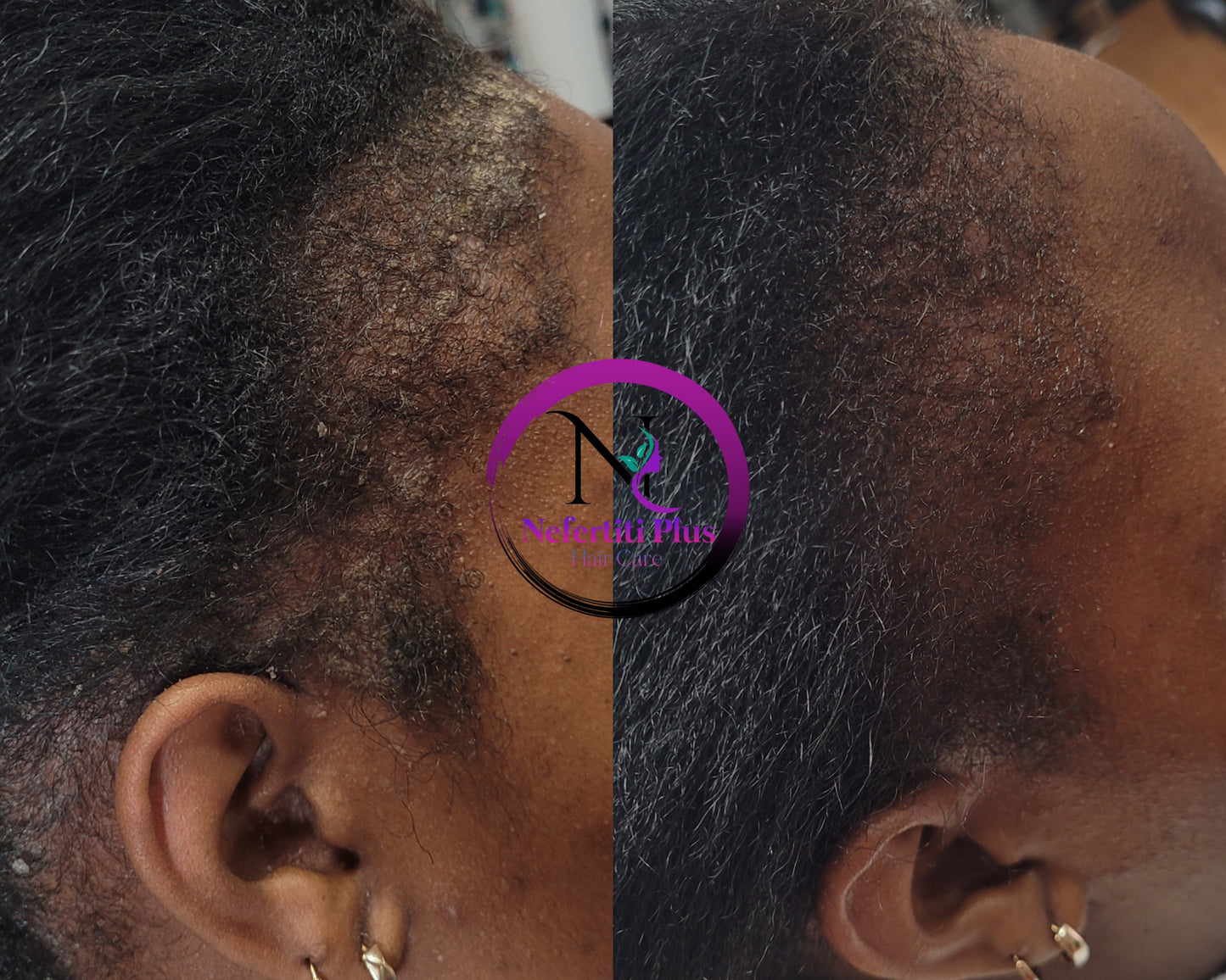SHAMPOOING ANTI-PELLICULES SÉVÈRE